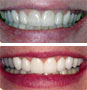 Dental Veneer