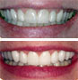 Dental Veneer