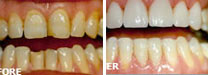 Dental Veneer