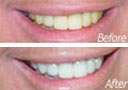 Dental Veneer