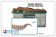 Spinal injections