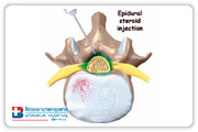 Spinal injections