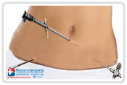 Minimally Invasive Surgery