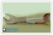 Upper Limb Prostheses