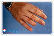 Fingers Prosthesis