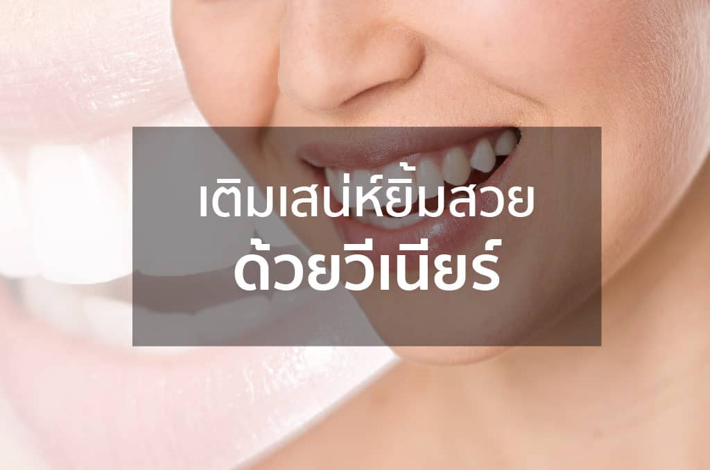 เติมเสน่ห์ยิ้มสวย ด้วยวีเนียร์