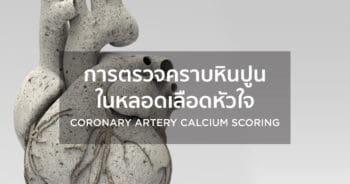 การตรวจคราบหินปูนในหลอดเลือดหัวใจ (Coronary artery calcium scoring)
