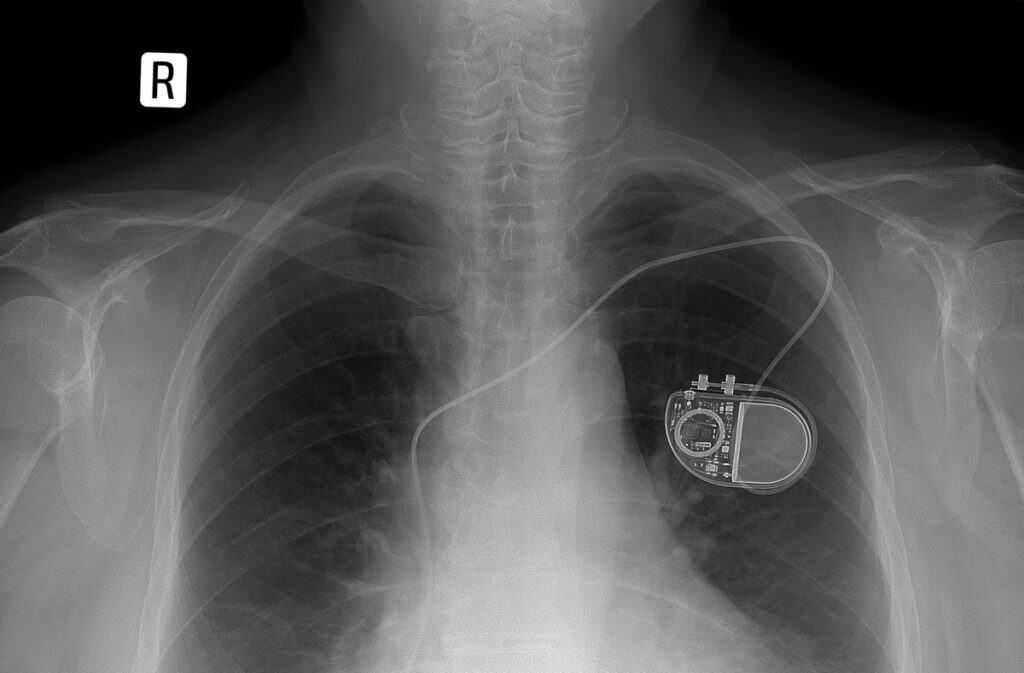 การใส่เครื่องกระตุ้นไฟฟ้าหัวใจ Pacemaker Implantation