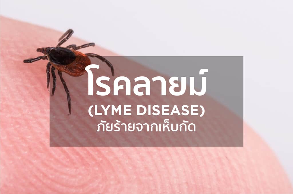 โรคลายม์ (Lyme disease) ภัยร้ายจากเห็บกัด