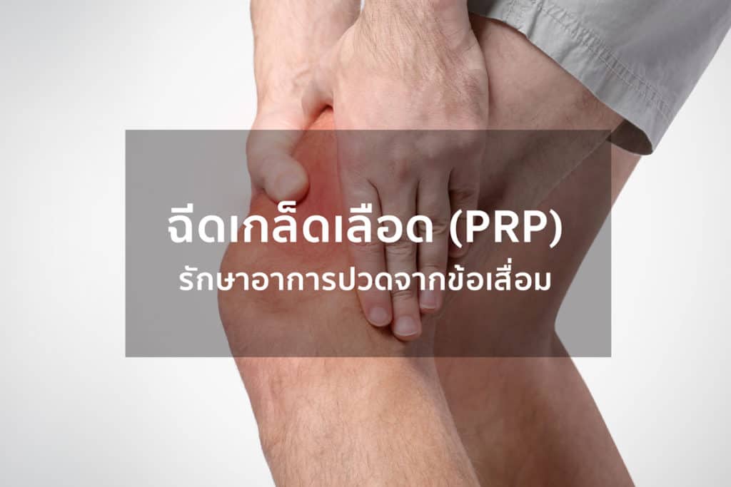 การรักษาโรคข้อเข่าเสื่อมโดยการฉีดเกล็ดเลือด