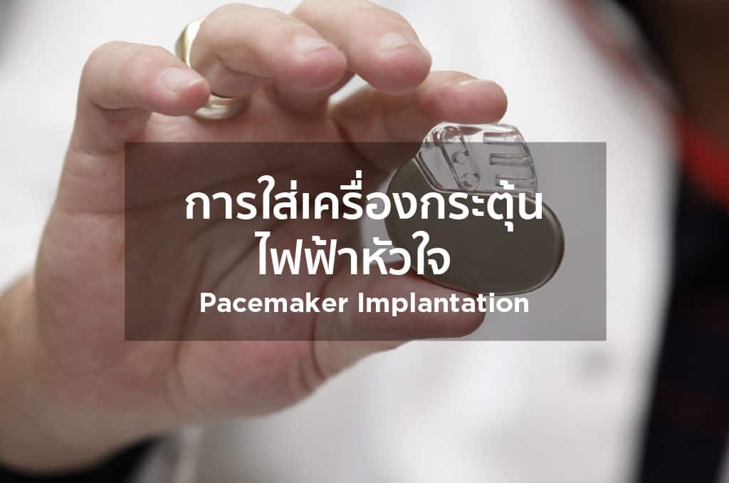 การใส่เครื่องกระตุ้นไฟฟ้าหัวใจ Pacemaker Implantation