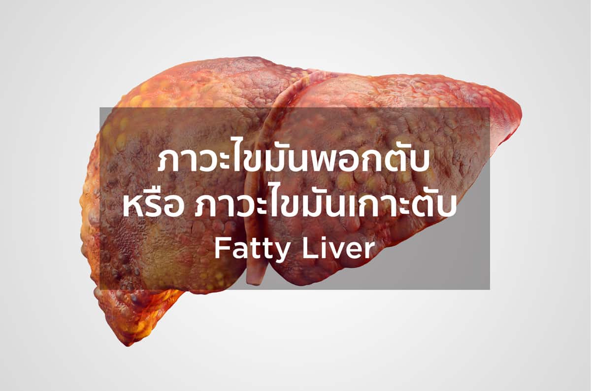 ภาวะไขมันพอกตับ (Fatty Liver)
