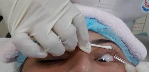 การนวดและทำความสะอาดเปลือกตา Eyelid Treatment | โรงพยาบาลกรุงเทพภูเก็ต
