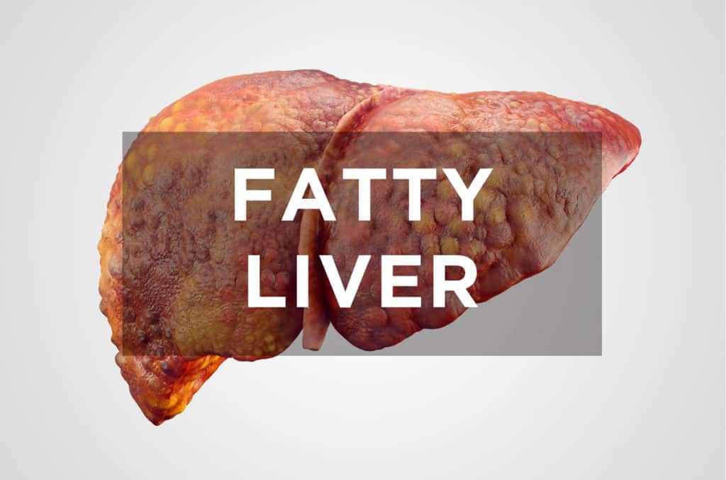 Fatty Liver