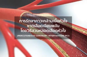 การรักษาภาวะกล้ามเนื้อหัวใจขาดเลือดเฉียบพลัน(Acute Myocardial Infarction) โดยวิธีสวนหลอดเลือดหัวใจ (Percutaneous Coronary Intervention: PCI)