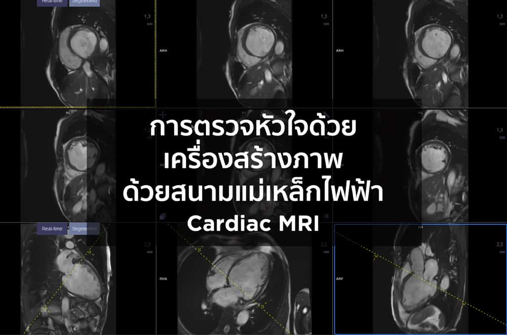 การตรวจหัวใจด้วยเครื่องสร้างภาพด้วยสนามแม่เหล็กไฟฟ้า (Cardiac MRI)