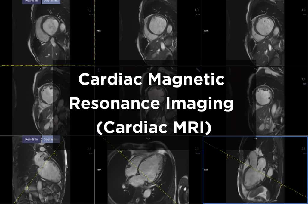 Cardiac Magnetic Resonance Imaging (MRI) scan