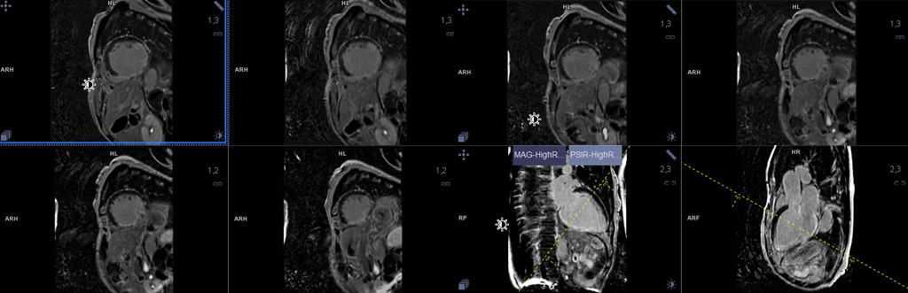 Cardiac Magnetic Resonance Imaging (MRI) scan