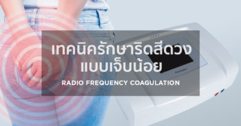 เทคนิครักษาริดสีดวงแบบเจ็บน้อย Radio Frequency Coagulation