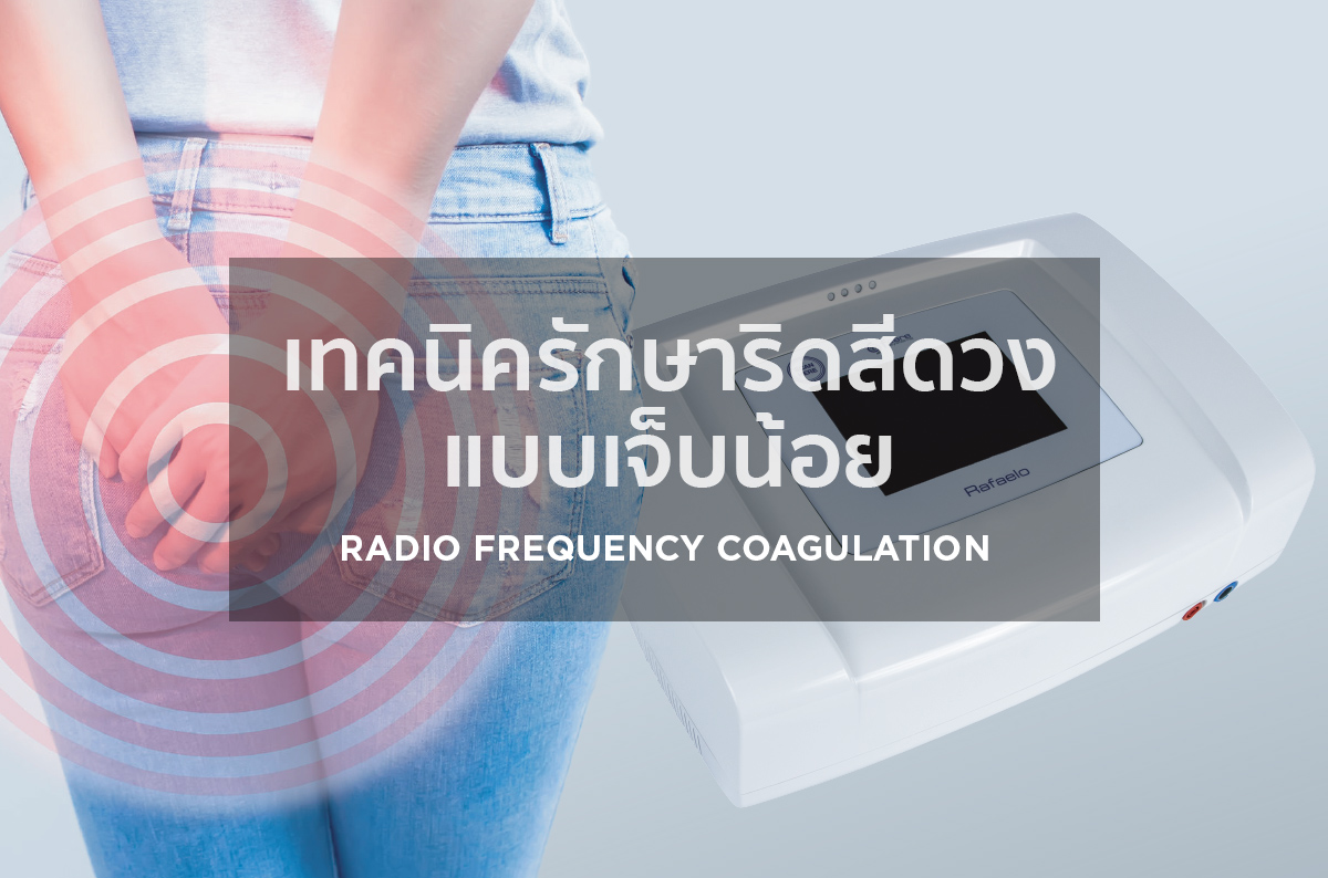 เทคนิครักษาริดสีดวงแบบเจ็บน้อย Radio Frequency Coagulation