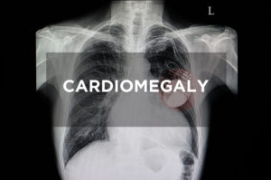 Cardiomegaly