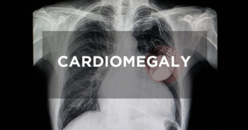Cardiomegaly