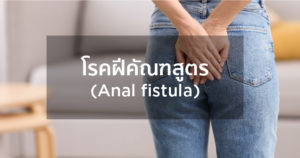 โรคฝีคัณฑสูตร