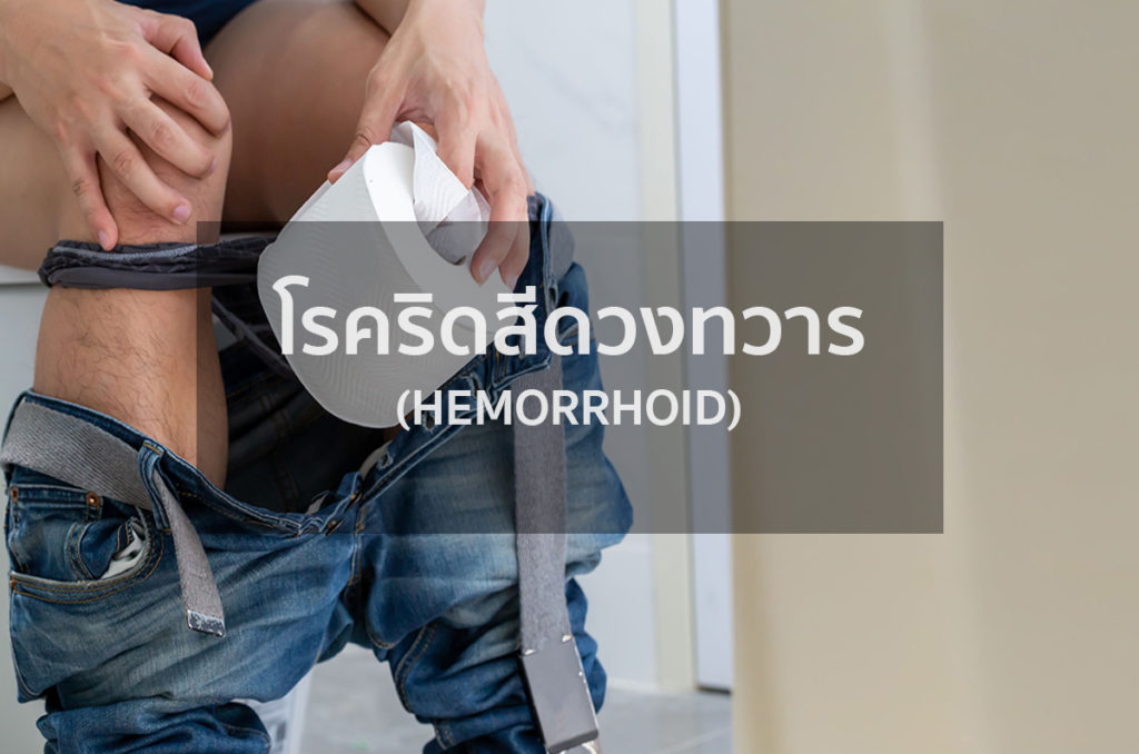 Hemorrhoid