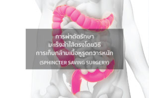 การผ่าตัดรักษามะเร็งลำไส้ตรงโดยวิธีการเก็บกล้ามเนื้อหูรูดทวารหนัก (Sphincter Saving Surgery)