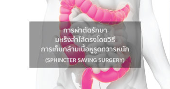 การผ่าตัดรักษามะเร็งลำไส้ตรงโดยวิธีการเก็บกล้ามเนื้อหูรูดทวารหนัก (Sphincter Saving Surgery)