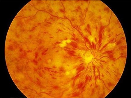 ภาพถ่ายจอประสาทตาของคนไข้ ที่มีภาวะเส้นเลือดอุดตันในตา
