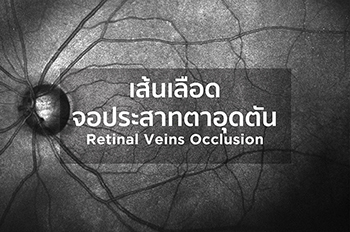 เส้นเลือดจอประสาทตาอุดตัน