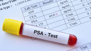 psa prostate antigen