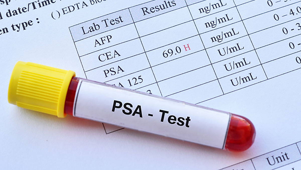 prostate specific antigen blood test