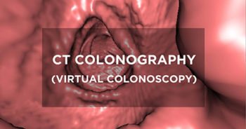 CT Colonography (Virtual Colonoscopy)