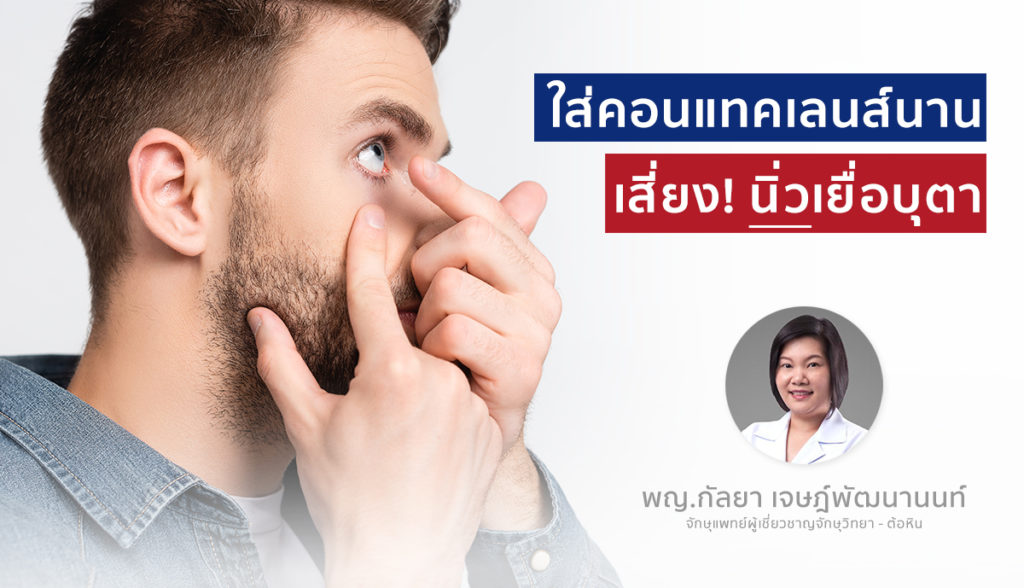 ใส่คอนแทคเลนส์นาน เสี่ยง! นิ่วเยื่อบุตา