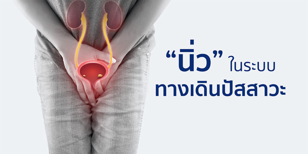 นิ่วในระบบทางเดินปัสสาวะ
