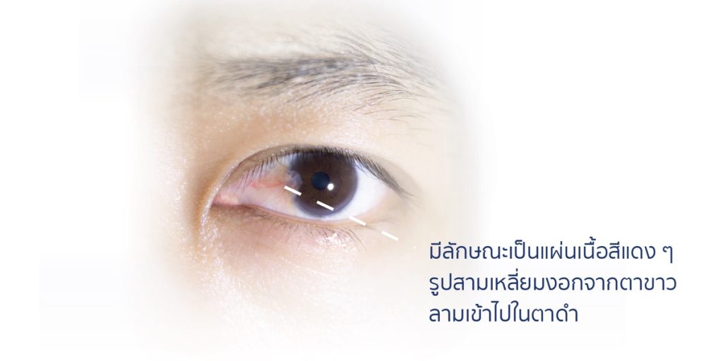 ต้อเนื้อ