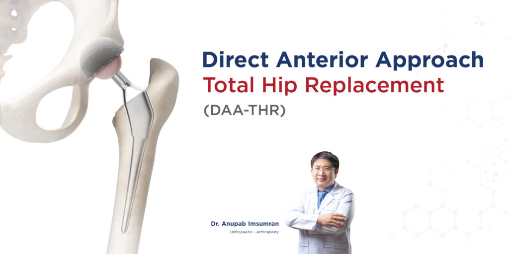 Direct Anterior Approach Total Hip Replacement (DAA-THR)
